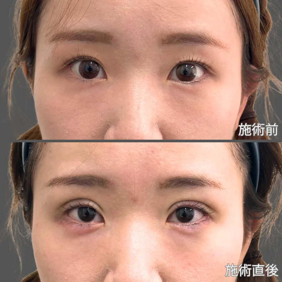 自然癒着法症例
