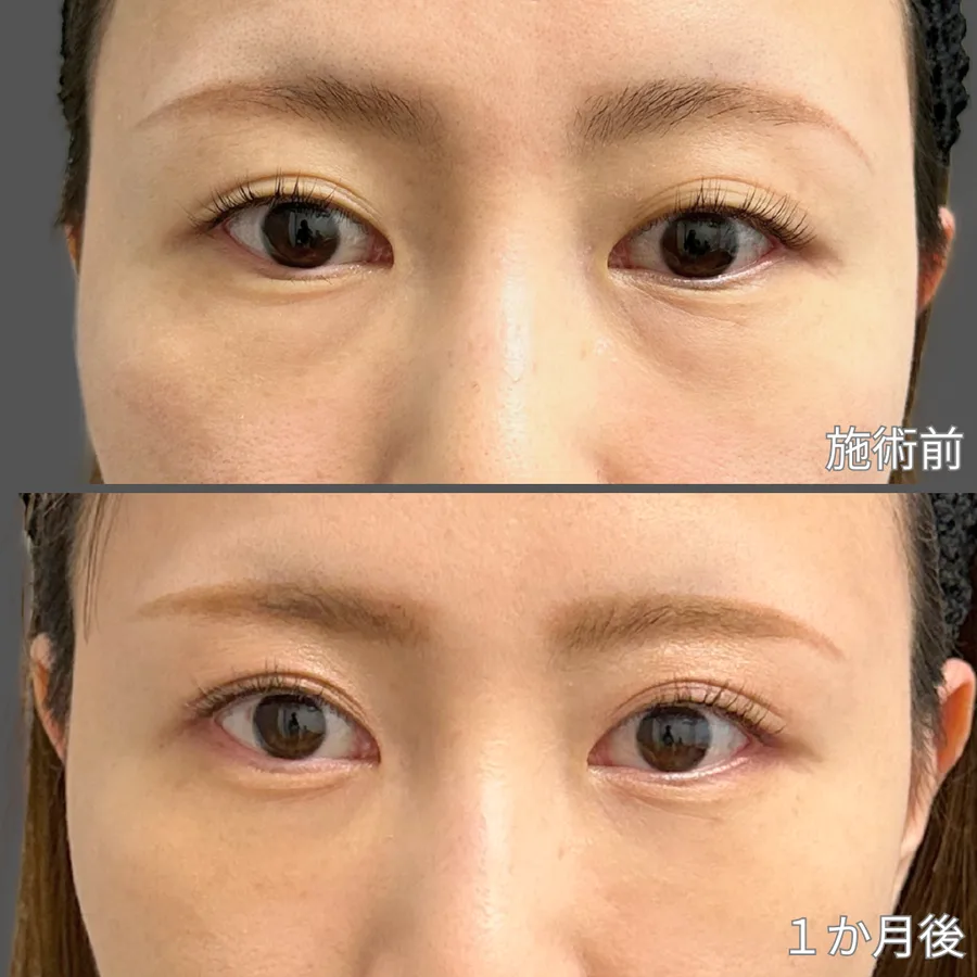 クマ取り施術症例写真