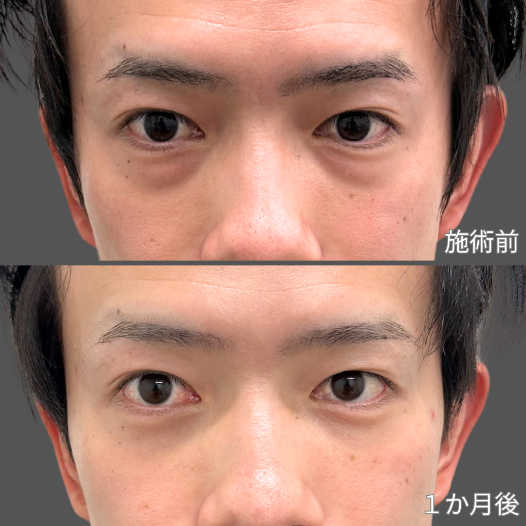 クマ取り施術症例写真