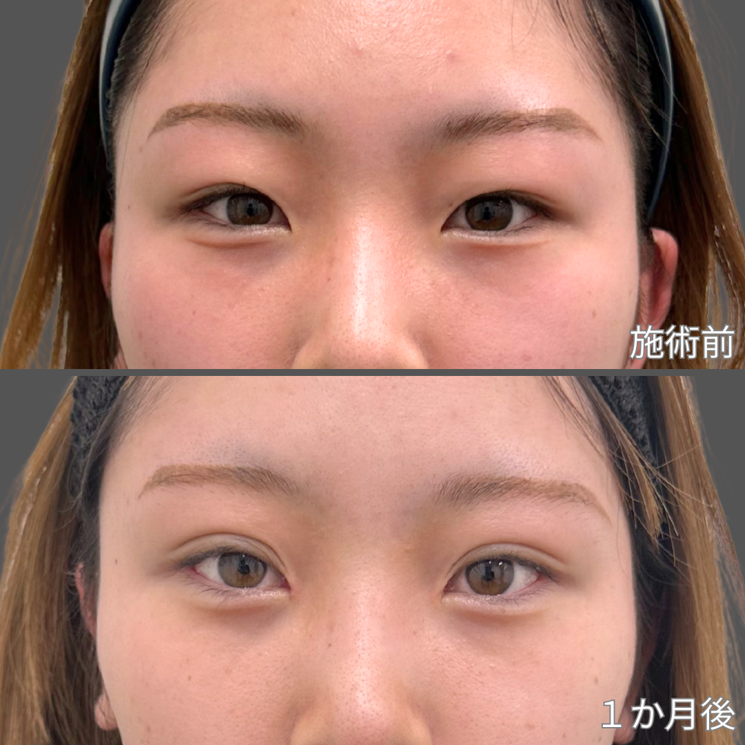 目元施術症例写真