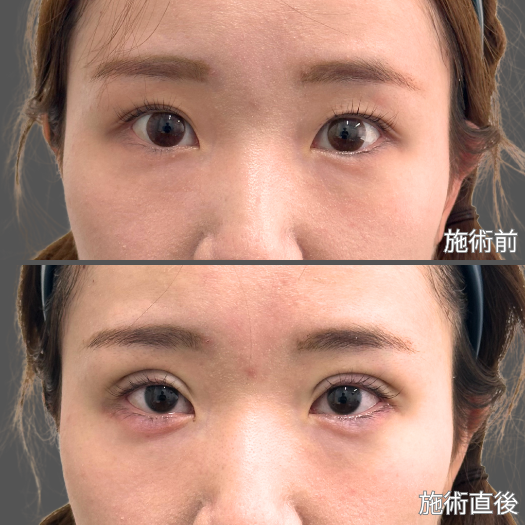 自然癒着法症例