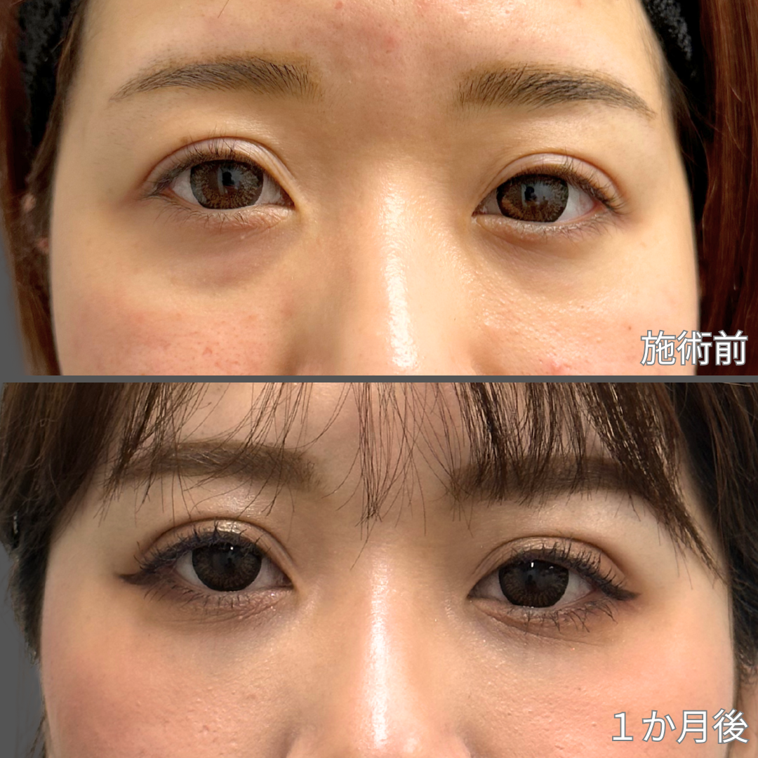 二重埋没症例写真