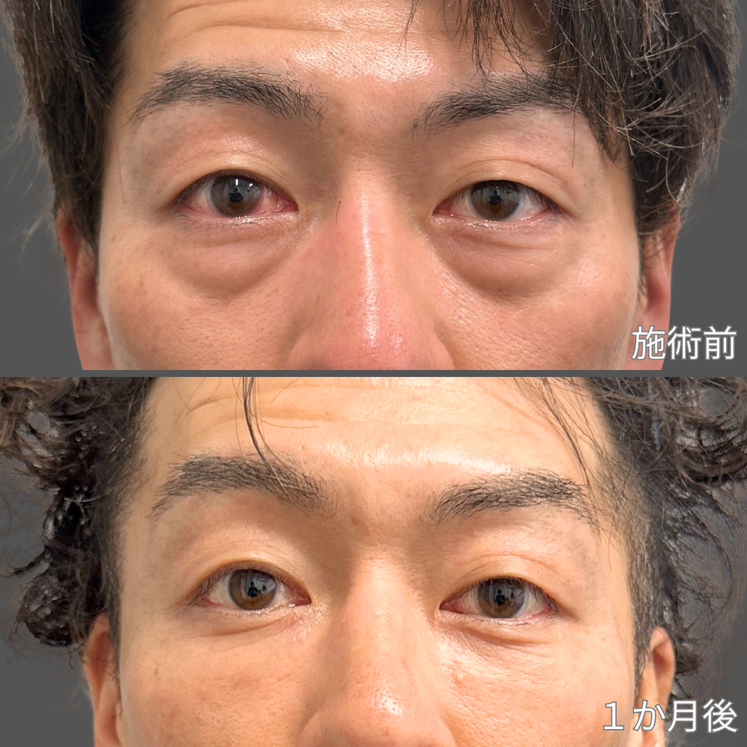 クマ取り施術症例写真