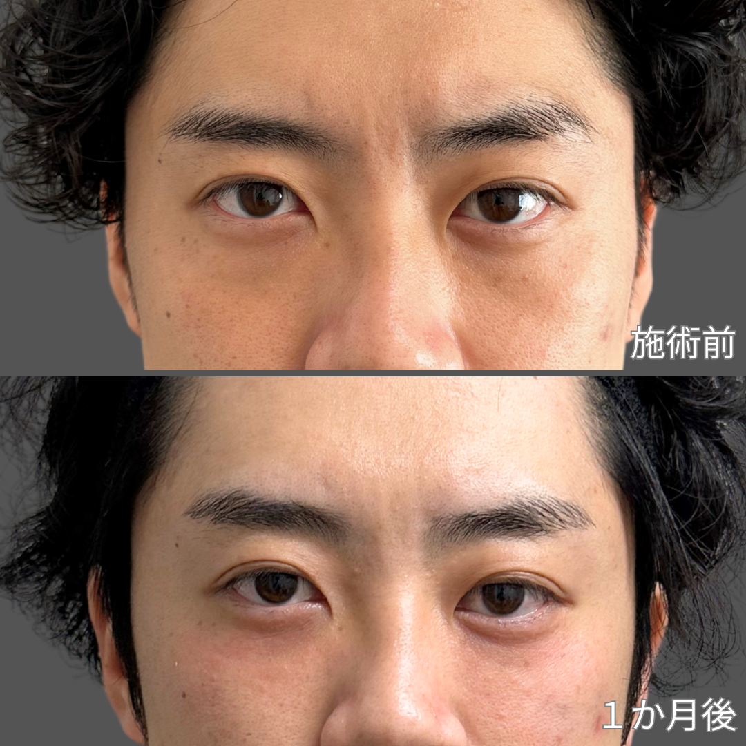 クマ取り施術症例写真